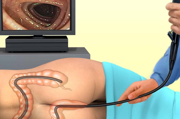 Колоноскопія кишечника – важливий крок до здорового майбутнього